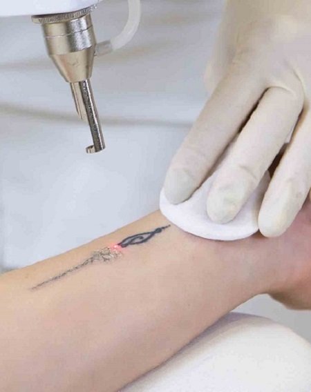 Laser Tattoo Removal in Processing