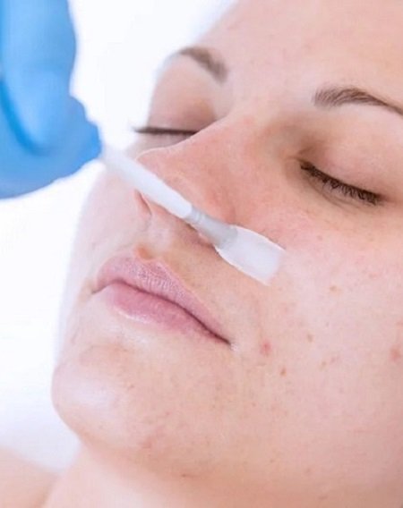 Skin Peels Treatment on face