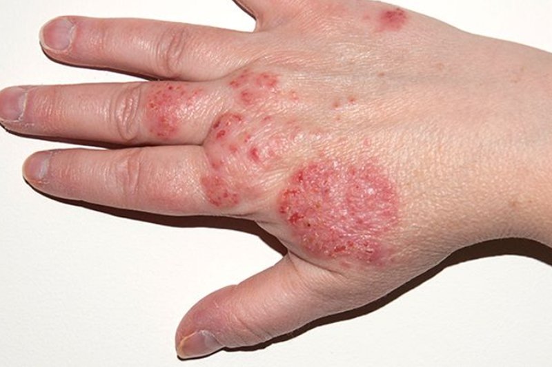 Eczema on hand