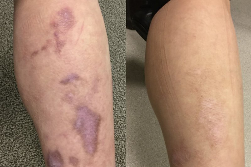 Legs Scar Shows Patient and after treatment shows result