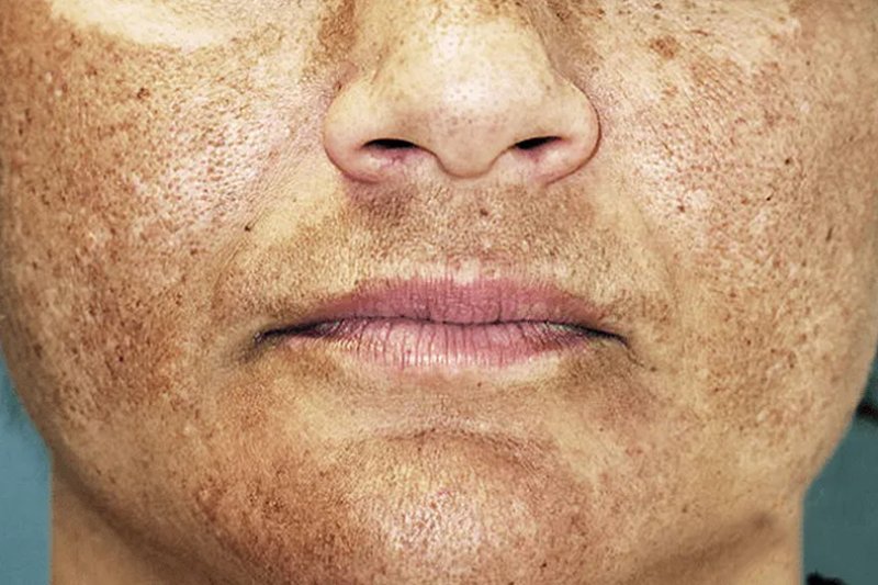 Melasma