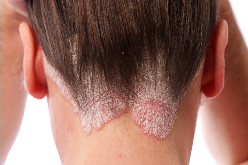 Hair Psoriasis