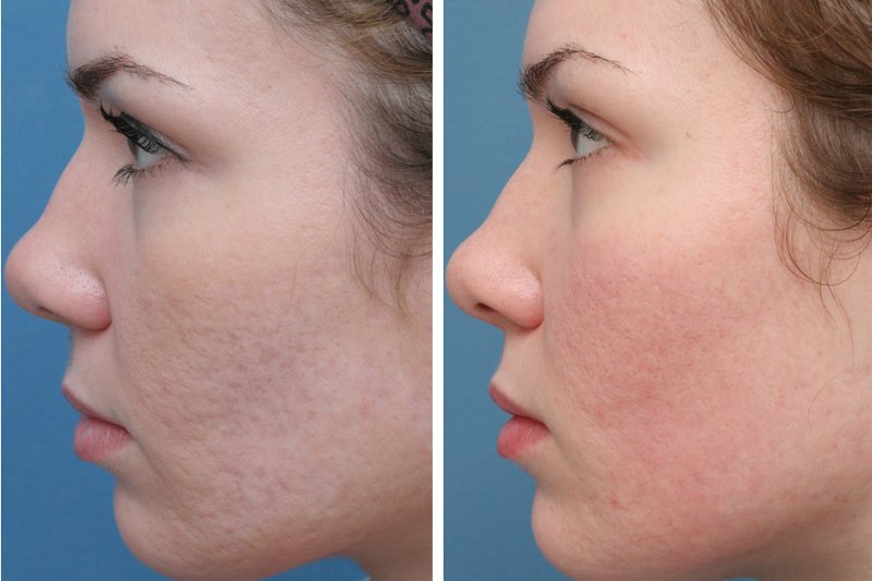 pimples recover scar on face after before result