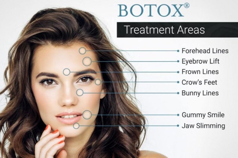 botox trratment areas