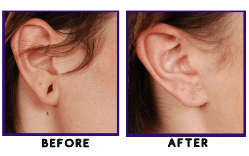 Ear whole after lobe repair treatment close the whole