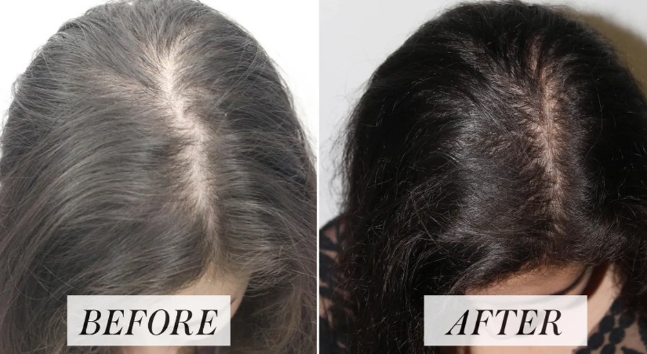 hair growth result after before treatment