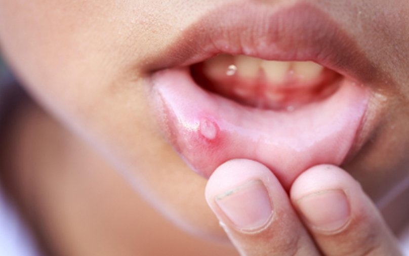 mouth ulcer tretment