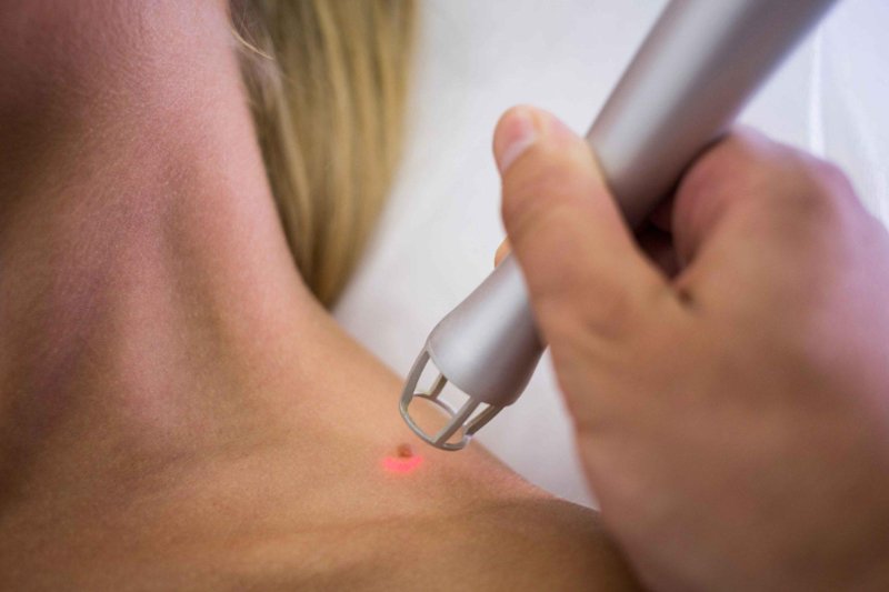 Wart Removal by Laser Treatment