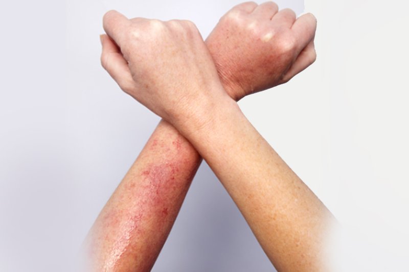 Photodermatitis