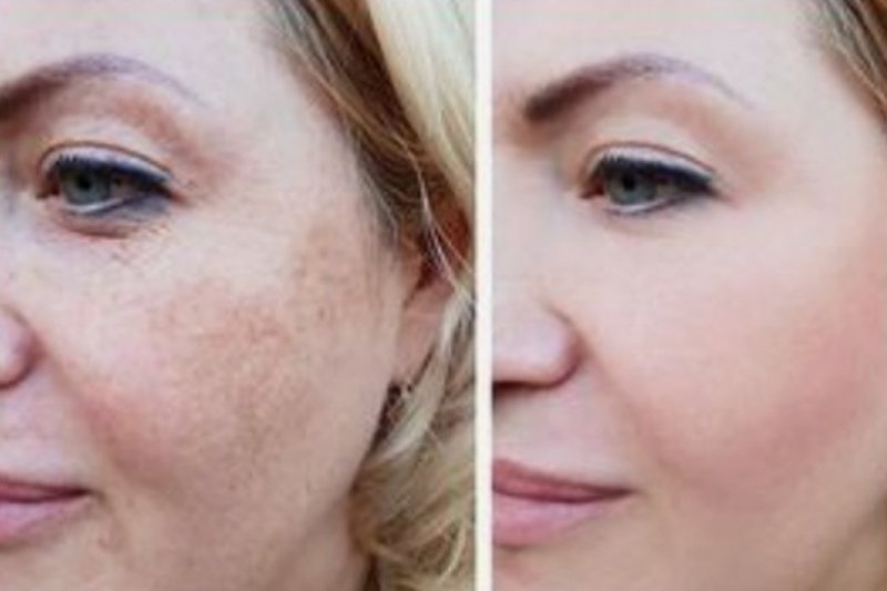 face pigmentation patient result shows