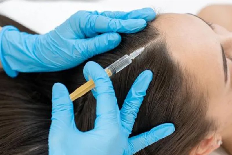 injecting medicine in hairs for PRP Treatment