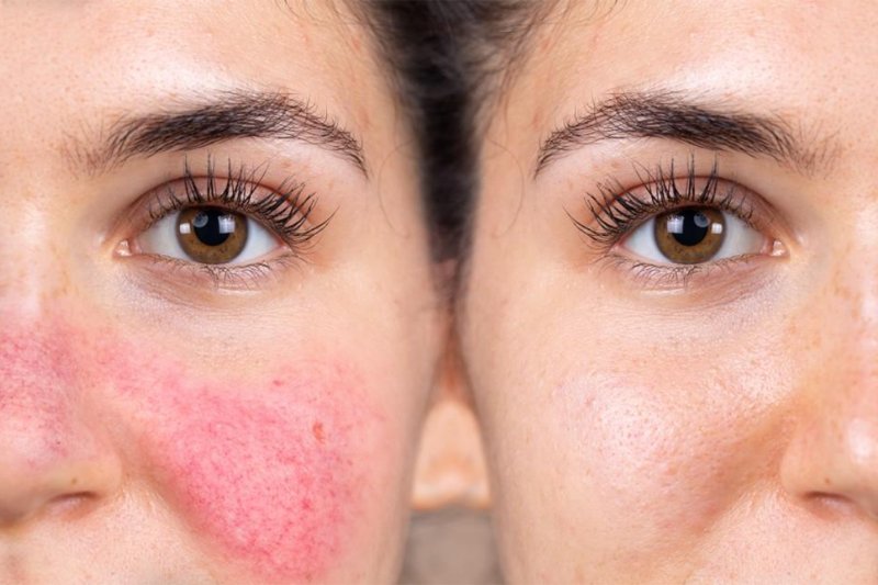 Rosacea