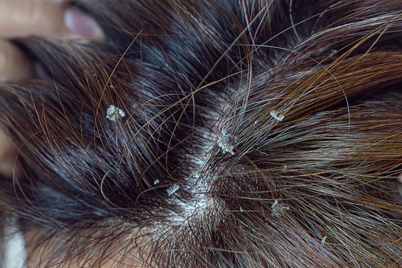 Hair Dandruff seborrheic dermatitis