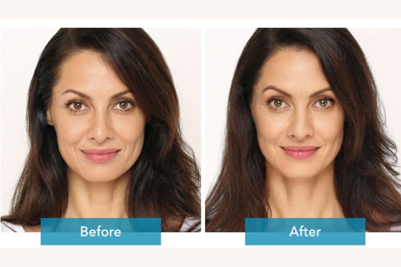 Face Contouring Treatment