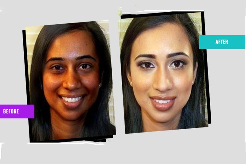 skin whitening After before result