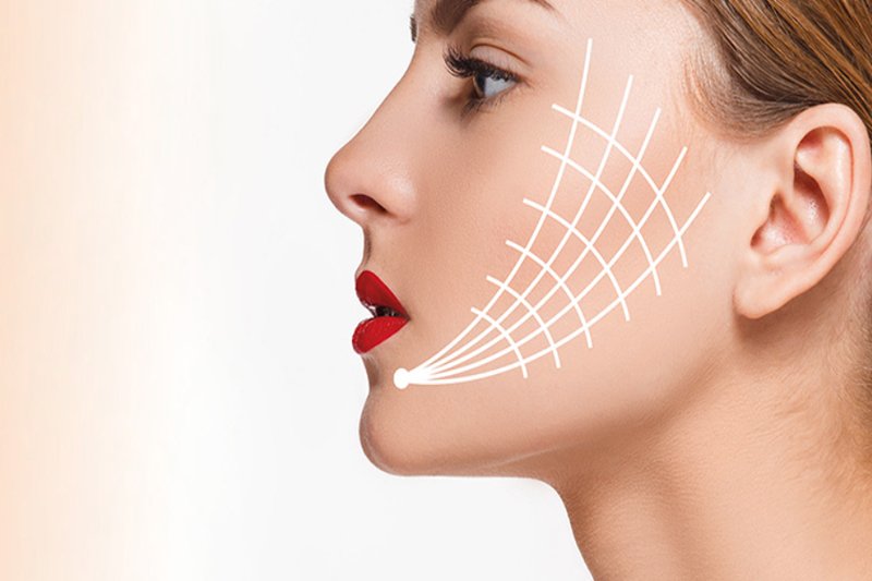 thread lift right side on face