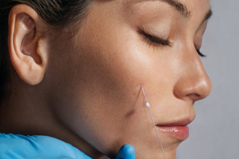 face injecting medicine liquid for thread lift