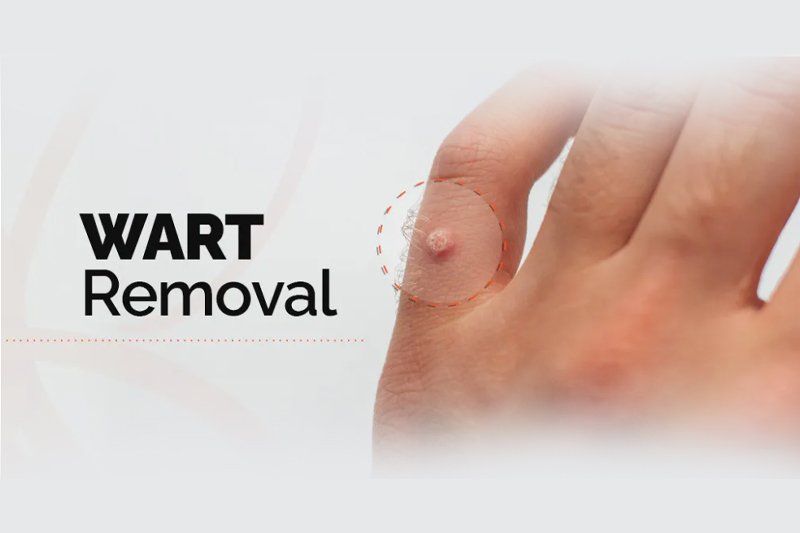 wart remove