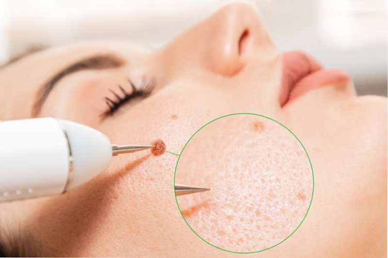 Removal of Moles & Skin-tags on face