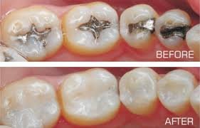 Tooth Coloured Fillings